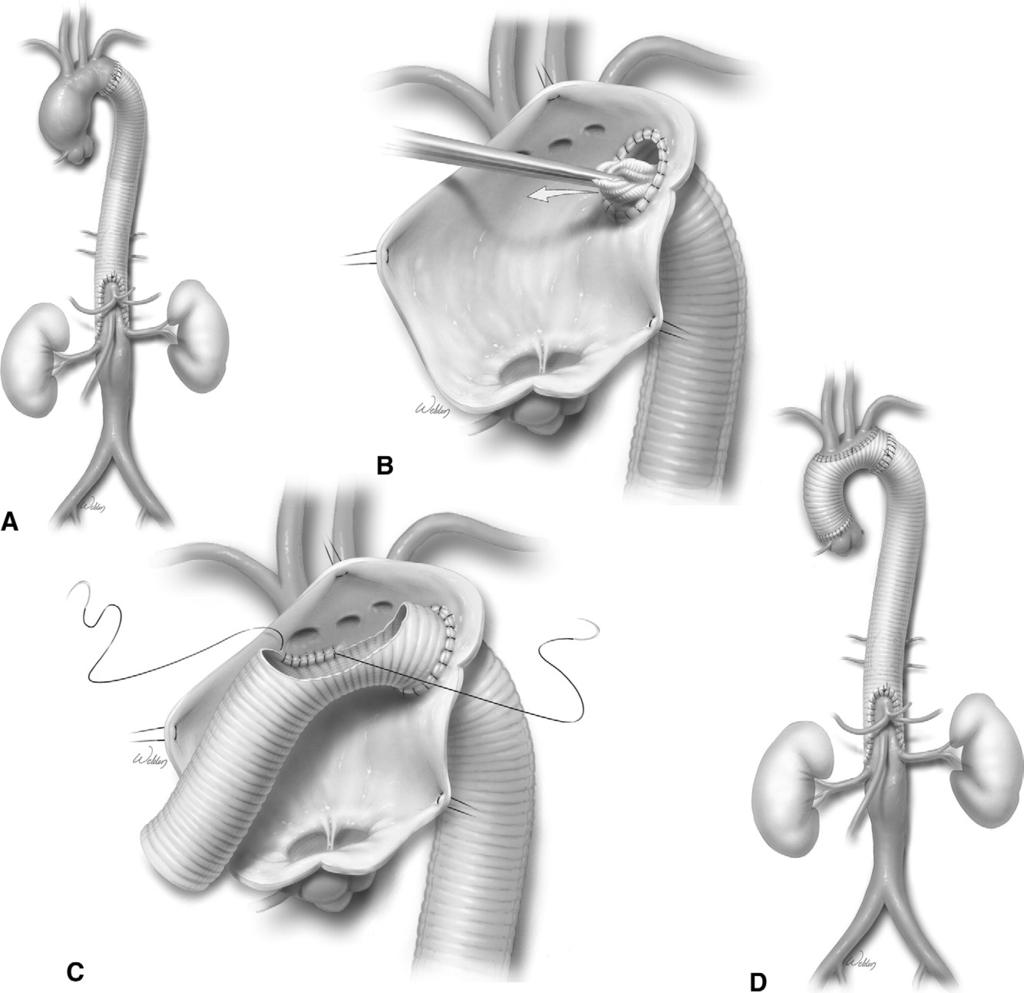 84 J. Huh et al Figure 15 (A) The completed first stage leaves a trunk suspended in the proximal aspect of the graft.