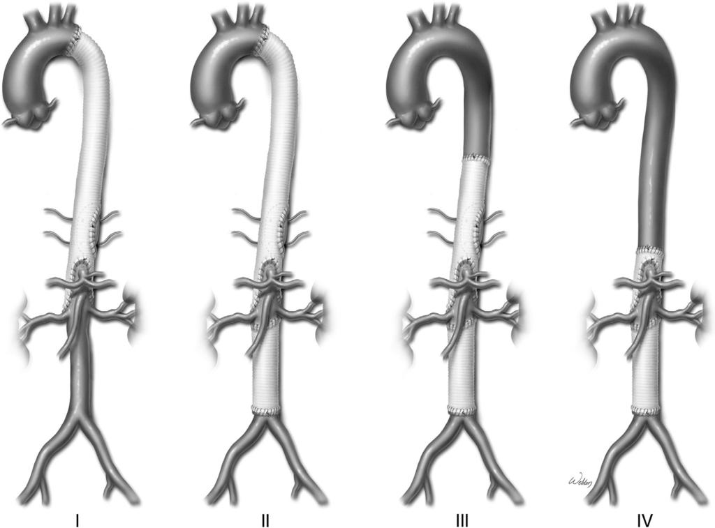 Thoracoabdominal aortic aneurysm repair: open technique 71 Operative Technique Figure 1 Crawford classification of thoracoabdominal aortic aneurysms.