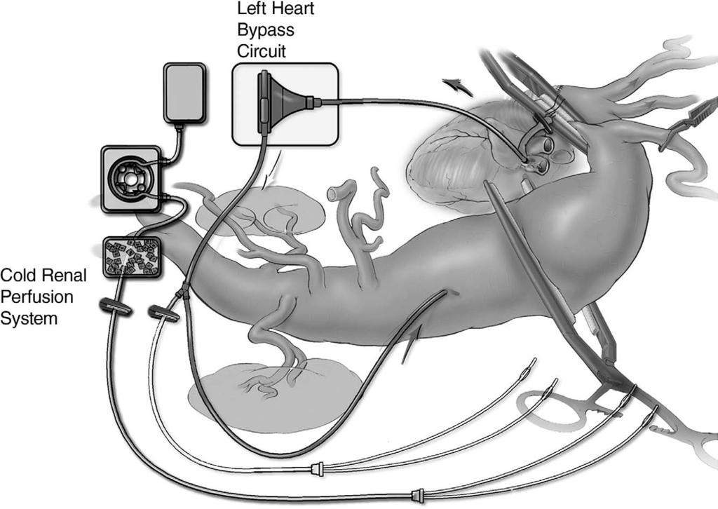 Thoracoabdominal aortic aneurysm repair: open technique 73 Figure 3 Left heart bypass, with flows between 1500 and 2500 ml/min, provides distal aortic perfusion while the proximal aorta is