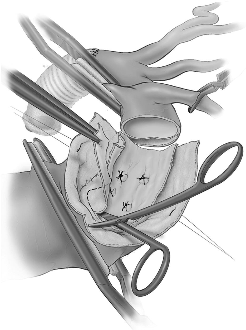Thoracoabdominal aortic aneurysm repair: open technique 75 Figure 5 The aorta is transected circumferentially. Clear visualization of the posterior wall prevents injury to the esophagus.