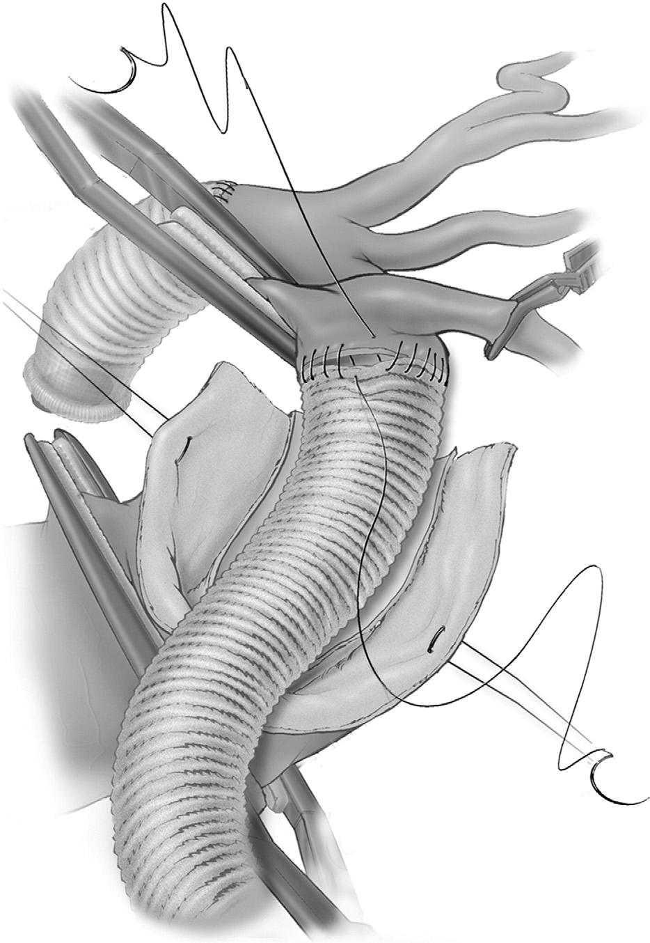 76 J. Huh et al Figure 6 Proximal anastomosis to a Dacron graft is completed by using 3-0 polypropylene suture.