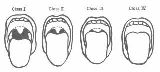 1: Size of tongue in relation to the size of oral cavity MALAMPATI CLASSIFICATION (Modification) Patient is asked to open mouth widely Class 1: Soft palate, fauces, uvula, anterior and posterior