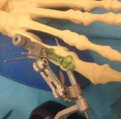 Step 1 Provisionally place the ORTHOLOC 3Di MTP Plate over the MTP joint using two temporary Fixation Pins (58820006).