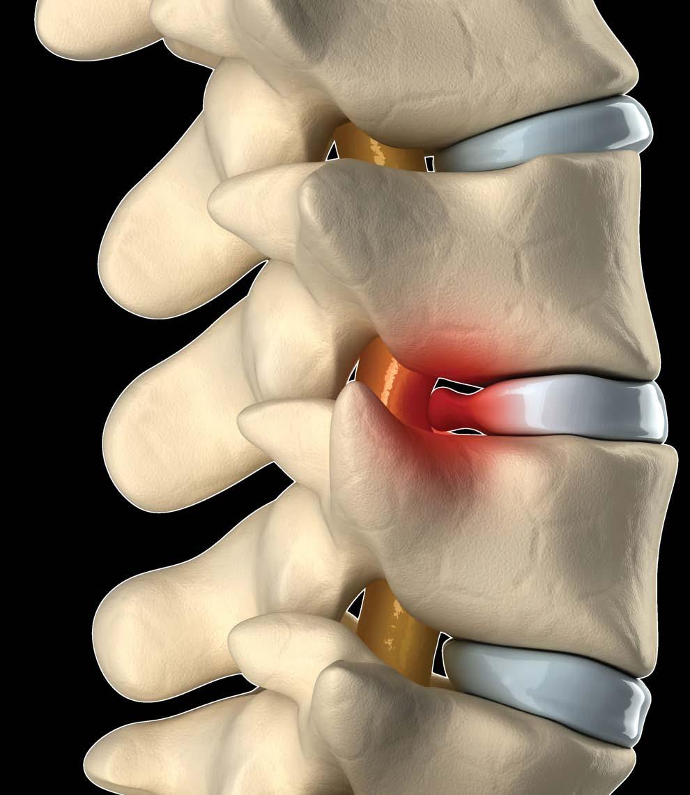 Herniated Disc Guide Understanding Causes, Treatment and Prevention Understanding the spine -- an amazing structure of bone, intervertebral discs, nerves and soft tissue -- can be difficult.