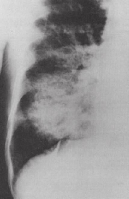 Once the CXR has been reviewed in a systematic fashion, examine the CXR for devices such as catheters, tubes, drains, or wires. Get into the habit of checking their position.