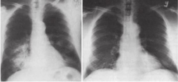 Close inspection of a consolidation may reveal an air bronchogram sign. This is a tubular outline of an airway made visible by filling of the surrounding alveoli by fluid or inflammatory exudates.