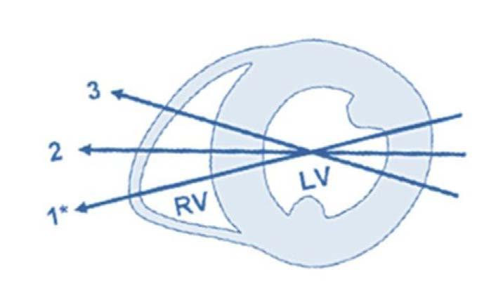 RV LINEAR DIMENSIONS RV Focused Apical 4 chamber View Advantages: easily obtained and a marker of RV dilatation.