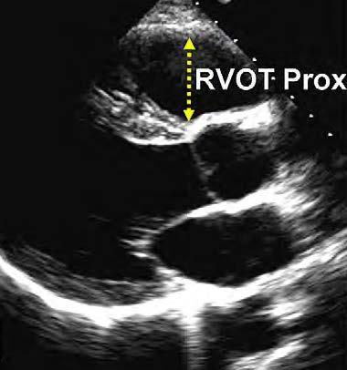 RIGTH VENTRICULAR OUTFLOW TRACT Proximal RVOT 30 mm Distal RVOT 35 mm 27mm