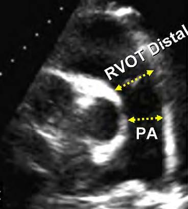 the RVOT, proximal and distal diameters of the RVOT should be measured from the