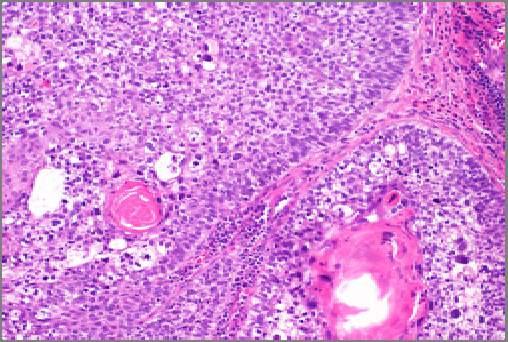 CK19 Expression Tumor Site (adenocarcinoma unless otherwise noted) Cholangiocarcinoma 100 Pancreas 100