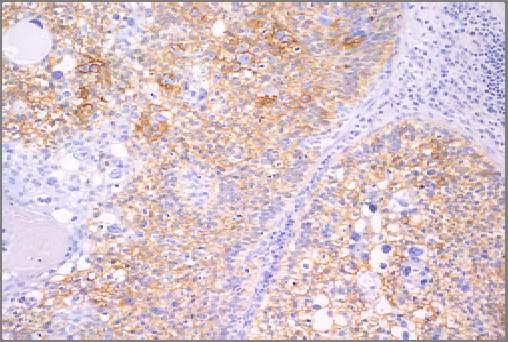 Melanoma, lymphoma, hepatocellular 0 % Positive (at 10% cells staining with moderate intensity) Gremel G, et