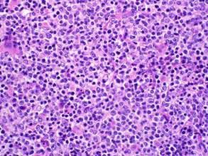 medullary carcinoma of the kidney, other INI1 deficient tumors (some epithelioid MPNST, myoepithelial CA of soft tissue, extraskeletal myxoid chondrosarc.