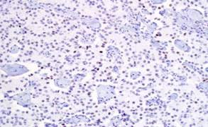 Small Cell Extrapulmonary Carcinoma