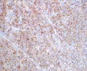 Pancreatoblastoma (PB) On cytology: dyshesive, monomorphic SPN: 3 of 6 misdiagnosed as PNET (Bardales et al 04) ACC: 2 of 4