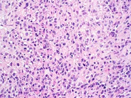 Trypsin Core biopsy from a 40 cm retroperitoneal tumor demonstrates undifferentiated neoplasm composed of sheets of
