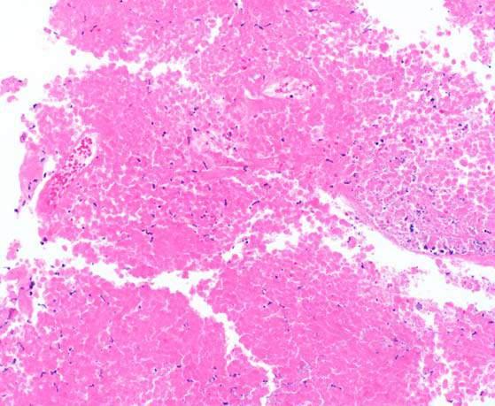 63 year old woman with liver, lung, and adrenal masses; presumed lung primary based on FNA of liver lesion 4 months