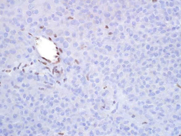 INI1: absent expression epithelioid sarcoma, proximal type 63 year old