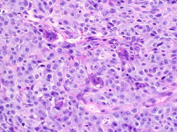 tissue extension Undifferentiated Malignant Neoplasm with Osteoclast