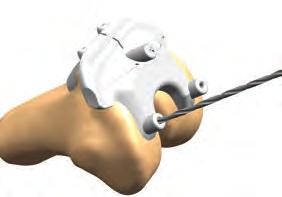 condyles Tip: The proximal part of the femoral block should rest on the anterior cortex to ensure that the block is not in flexion 2 Allow the