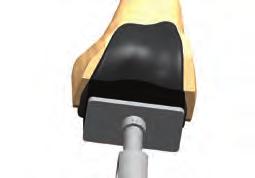 and punch through tibia baseplate trial Implantation 25 Remove trial