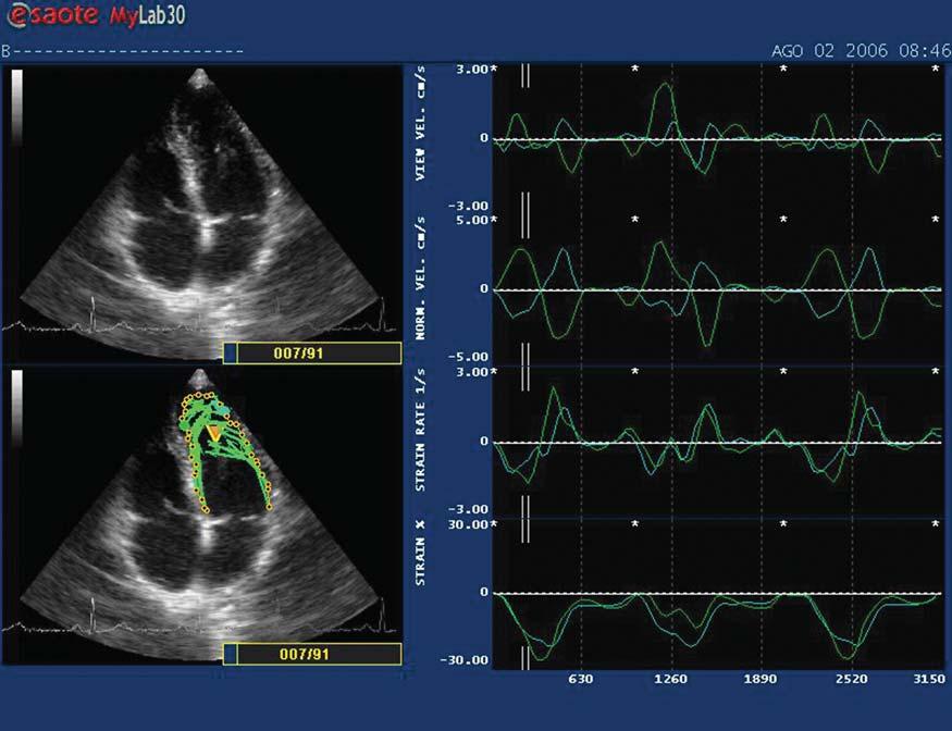 LV performance in young athletes with BAV 529 Figure 1 Assessment of strain in the left ventricle using the X-Strain programme.