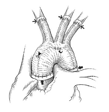 CT of ortic Graft Complications Fig. 3 Drawing shows total aortic arch replacement with separate individual great vessel anastomoses.