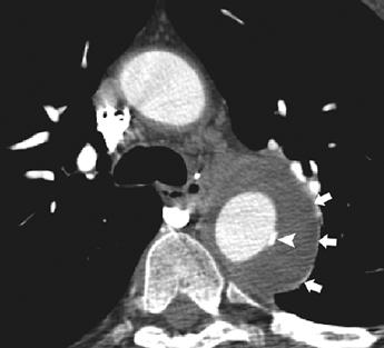 In three of the six patients, follow-up CT examinations 8 51 months later showed stable findings. Two additional patients did not undergo imaging follow-up.
