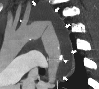 fter detection of the abnormal contrast collection on imaging, aspirin was suspended, and the imaging finding was not present on CT 4 months later.