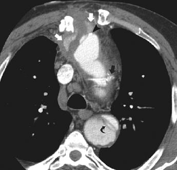 CT of ortic Graft Complications Fig. 7 47-year-old man taking anticoagulation therapy 27 months after aortic arch replacement for chronic type aortic dissection.