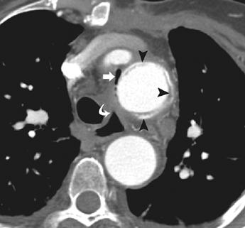 Our data suggest that thoracic aortic graft complications are uncommonly detected at CT.