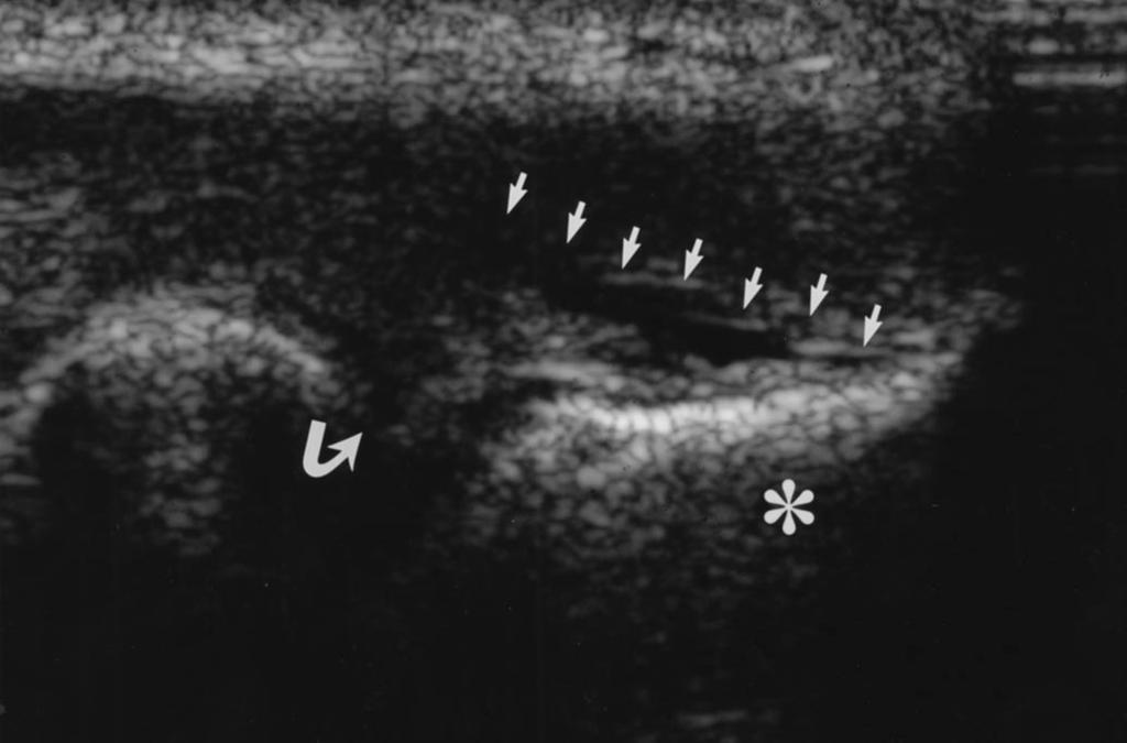 and behind the foci. Twenty-one of the 72 elbows underwent surgery, and the sonographic findings were confirmed in all patients.