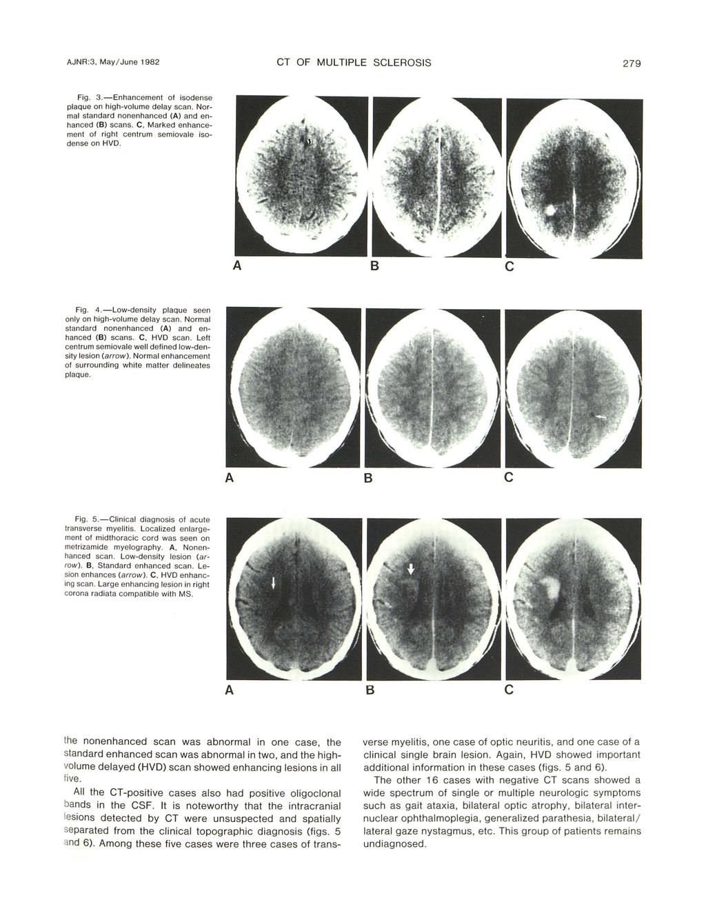 JNR:3, May/ June 1982 CT OF MULTIPLE SCLEROSIS 279 Fig. 3.-Enhanement of isodense plaque on high-volume delay san. Normal standard nonenhaned () and enhaned () sans.