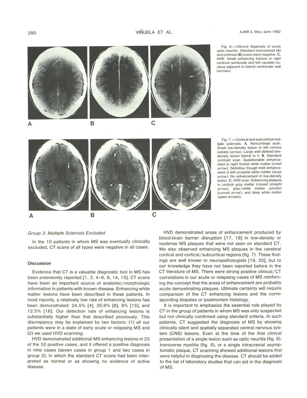 280 VINUEL ET L. JNR:3, May/ June 1982 Fig. 6. - Clinial diag nosis of aute opti neuritis. Standard nonontrast () and ontrast () sans were negative. C, HVD.