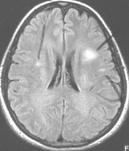 Does stroke occur due to migraine / aura? Etminan, Mahar; Takkouche, Bahi; Isorna, Francisco Caamaño; Samii, Ali.