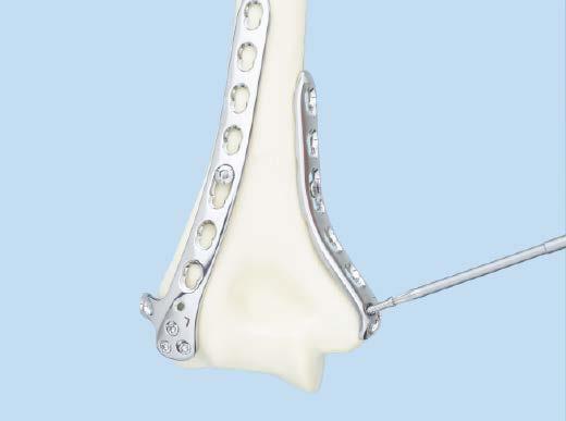 Precautions: Careful drilling is necessary as collision with the screws of the posterolateral plate may occur.