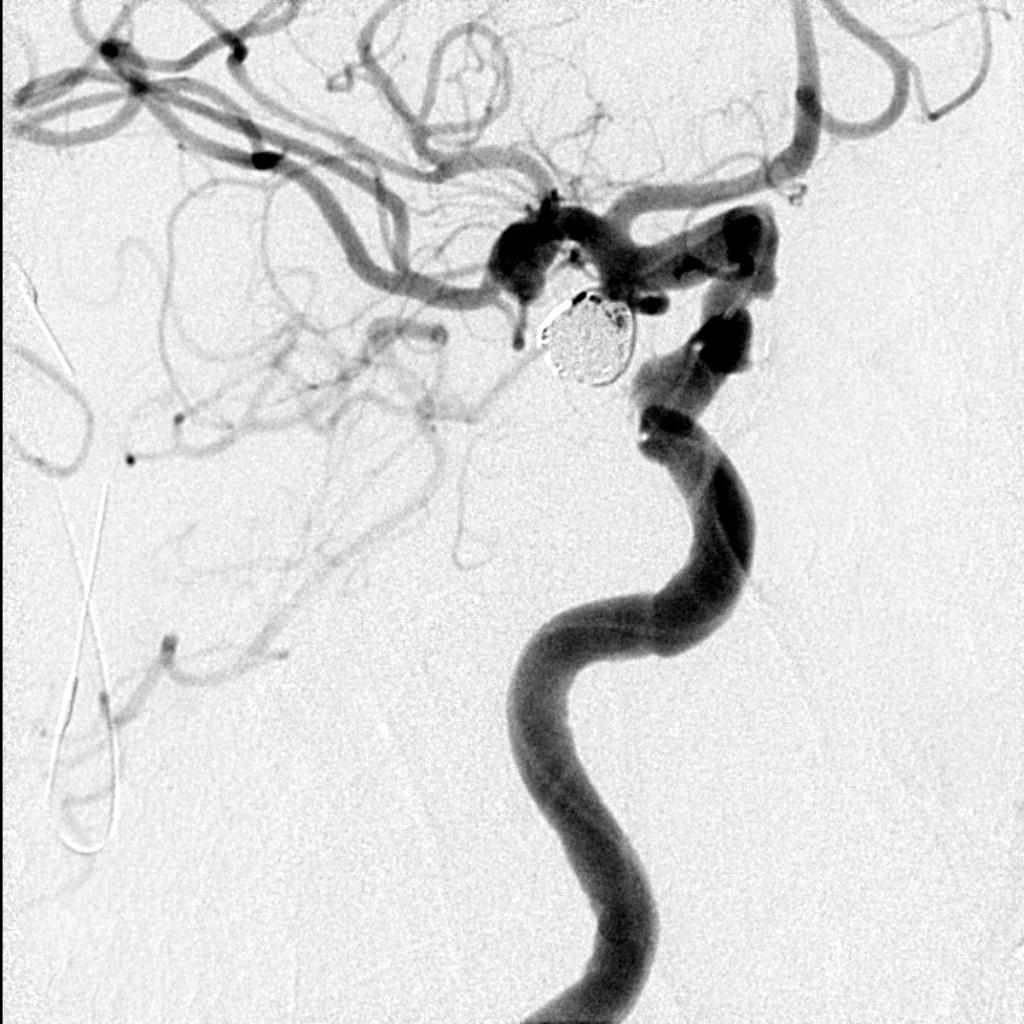 R PCA aneurysm post coil
