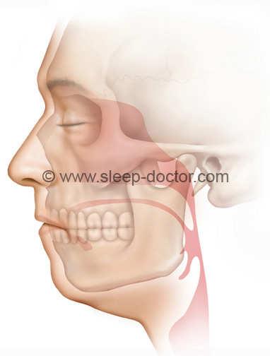 Partial Epiglottectomy Resection of portion of epiglottis Below: central suprahyoid vs.
