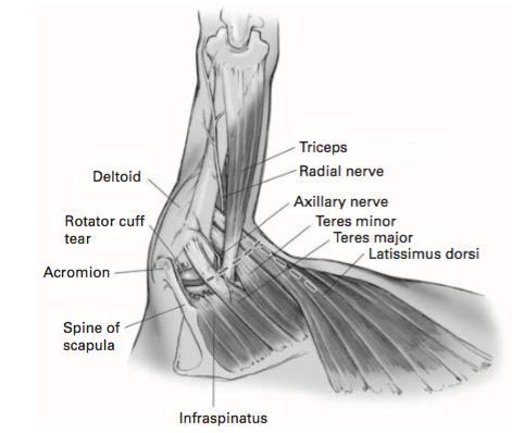 Latissimus Dorsi Tendon Transfer -Reattach latissimus dorsi tendon to near the infraspinatus