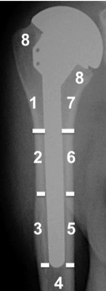 Humeral component loosening Lucency surrounding the humeral component divided into zones *Humeral component considered at risk for loosening if 3