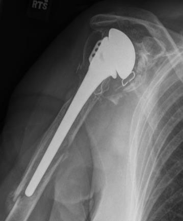 the entire length of the humerus for assessment *Type B fractures have a high rate of nonunion with nonoperative treatment