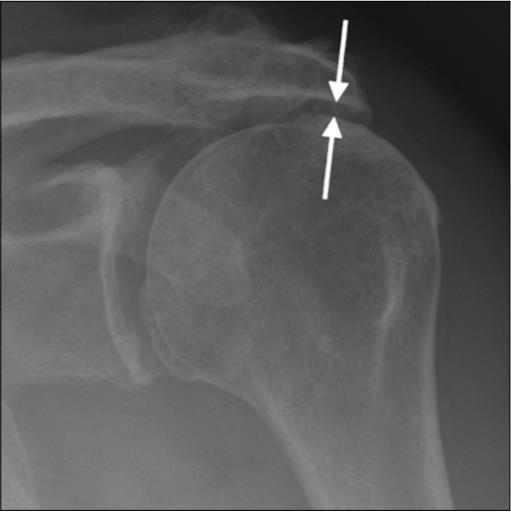 Acromiohumeral distance 7mm associated with rotator cuff