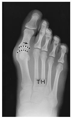 Figs. 1-A, 1-B, and 1-C: Radiographs demonstrating the different degrees of a hallux valgus deformity.
