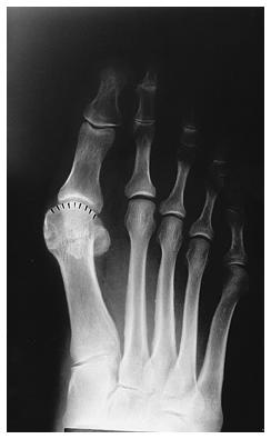 1-A: A mild hallux valgus deformity with subluxation of the first metatarsophalangeal joint.