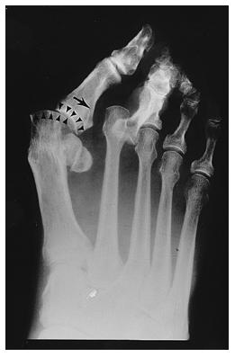 Fig. 1-C: A severe, recurrent hallux valgus deformity with severe subluxation of the first metatarsophalangeal joint.