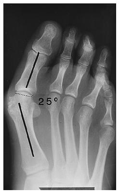 The second metatarsophalangeal joint is dislocated. Radiograph of a foot with moderate hallux valgus deformity without subluxation of the first metatarsophalangeal joint.