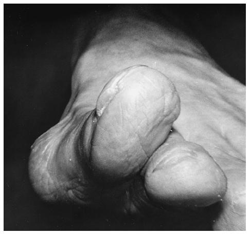 pronation of the great toe.