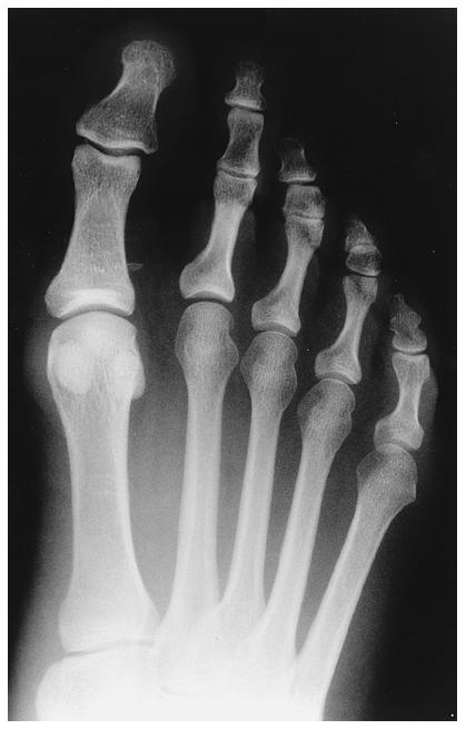 Figs. 8-A through 8-F: Radiographs showing normal alignment and subluxation of the sesamoids. Figs. 8- A and 8-B: Anteroposterior (Fig.