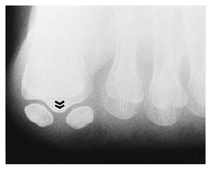 8-B) radiographs made with the patient standing, demonstrating the normal alignment of the sesamoids with a straight great toe.