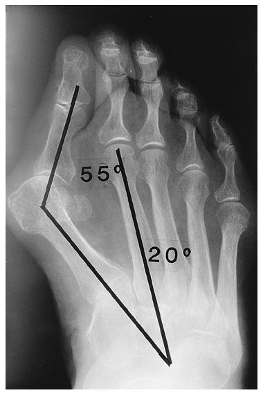 Anteroposterior (Fig. 8-E) and axial (Fig. 8-F) radiographs, made with the patient standing, showing a severe hallux valgus deformity.