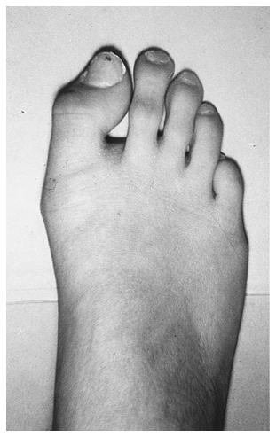 Fig. 10-C: A hallux valgus deformity with a congruous metatarsophalangeal joint